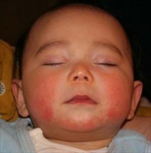 赤ちゃんの湿疹の原因は 顔や全身のケア方法を紹介 ママの教科書 妊活 妊娠 子育てを楽しもう