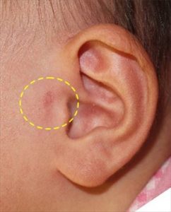 副耳の手術費用